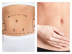 Antes y después de una abdominoplastia: proceso y postoperatorio