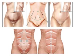 Cicatrices de la abdominoplastia