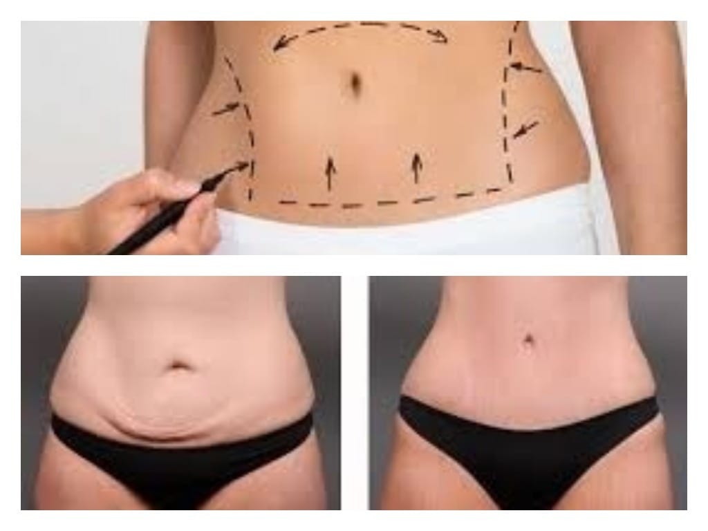 dermolipectomia u operacion estética de abdomen drmolto