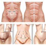 cirugía plástica de abdomen en Valencia