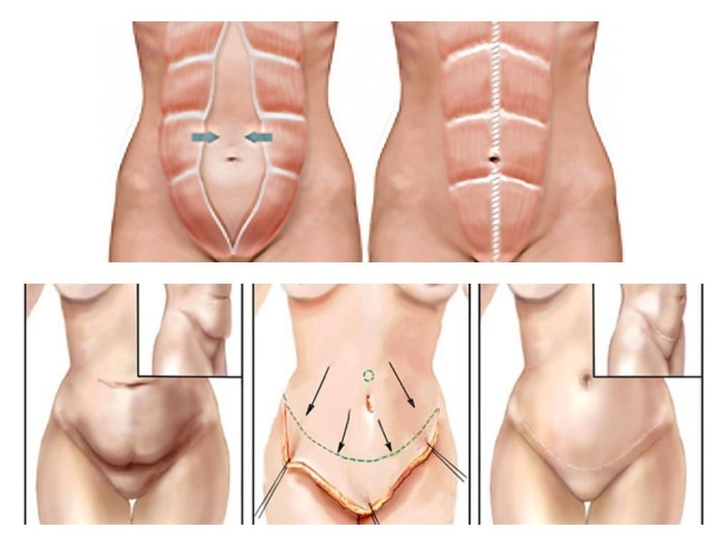 cirugía plástica de abdomen 