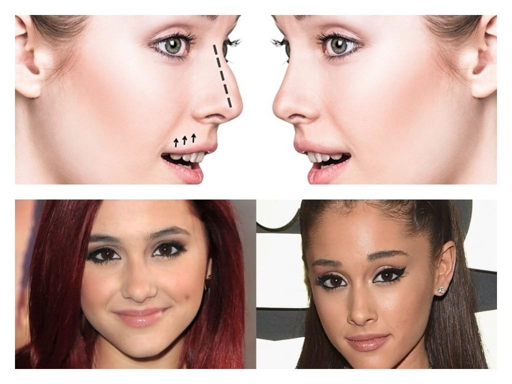 antes y despues cirugía nasal