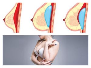 diagrama de colocación de implantes y mujer con pechos aumentados