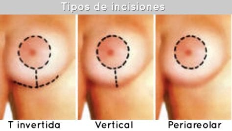 dibujo de diferentes incisiones de cirugia de pechos