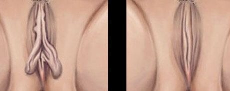 dibujo de un antes y después de una vaginoplastia, una de las operaciones de estética genital para mujer más solicitadas.