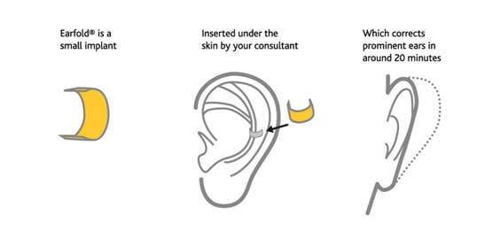 Otoplastica con earfold: Como actúa el dispositivo