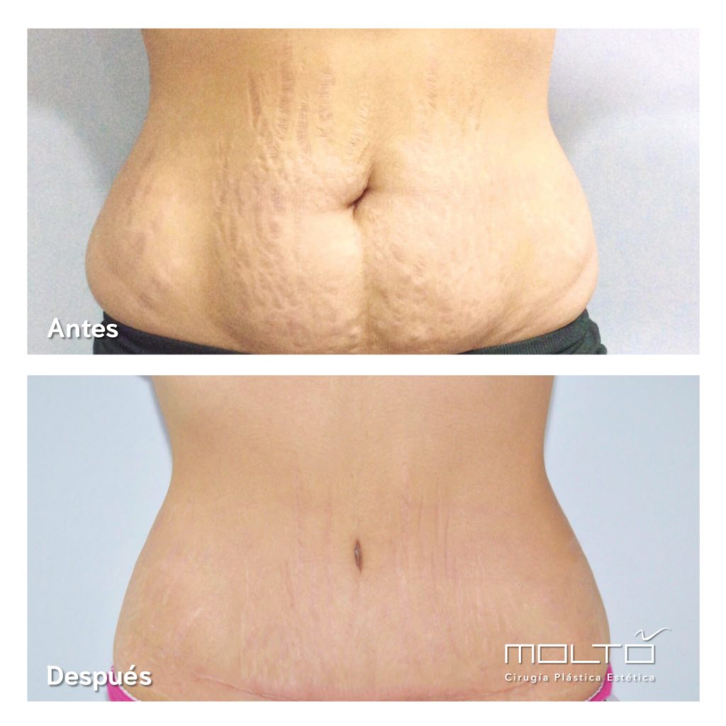 Abdominoplastia sin cicatriz. 