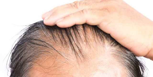 Tratamientos para la caída del cabello