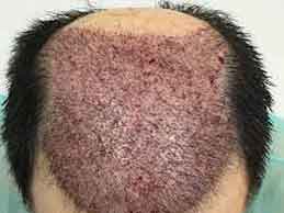 recuperacion dia a dia tras trasplante de pelo en Valencia con el Dr. Moltó
