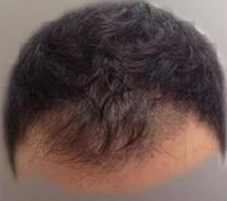 injerto capilar 3 meses después del injerto