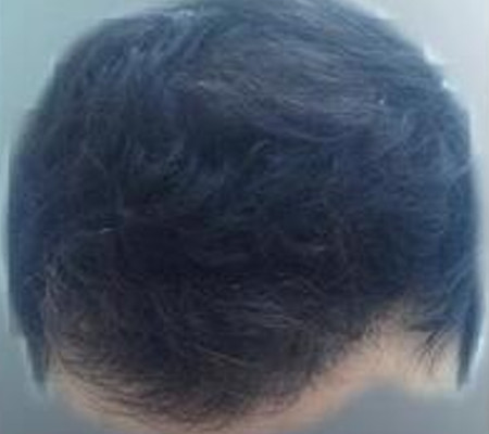 A los 6 meses del trasplante de pelo