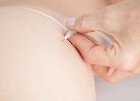 El Dr. Moltó realiza tratamientos de mesoterapia, carboxiterapia y alidya para combatir la celulitis.