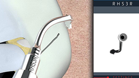 Herramienta de ultrasonidos para la rinoplastia.