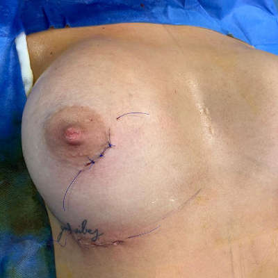 incisiones de la mamoplastia con extraccion de fibroadenoma