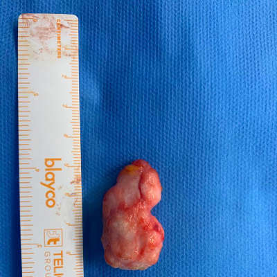 fibroadenoma o quiste extraidp durante la cirugia de mamas tuberosas