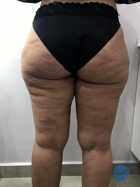 TENGO LIPEDEMA. ¿QUÉ MEDIAS DEBO - clinicaconstanza