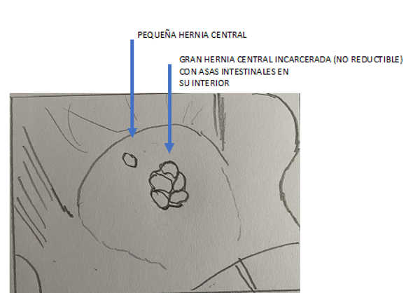 diagrama del caso de abdominoplastia con 2 hernias abdominales