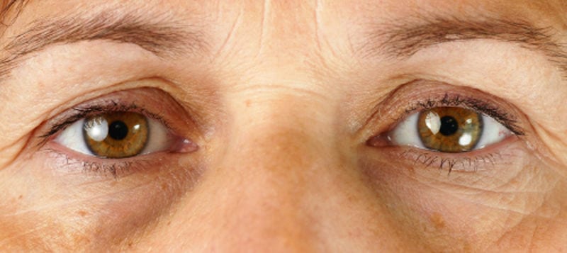 blefaroplastia y cantopexia