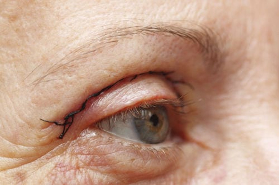 Blefaroplastia antes y después: Fotos reales
