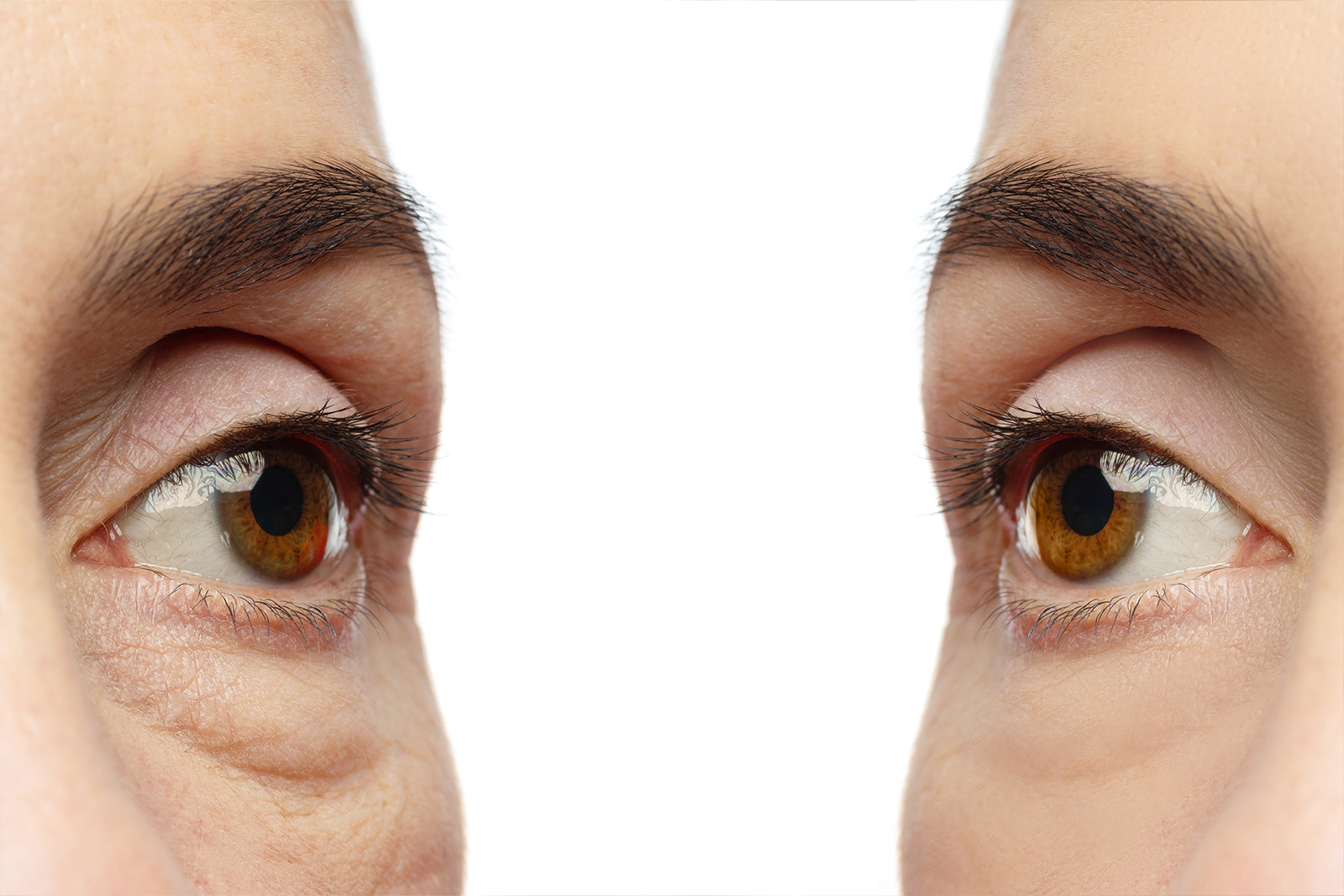 Blefaroplastia en Valencia y Gandía: Cirugía estética de párpados