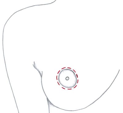 Mastopexia periareolar