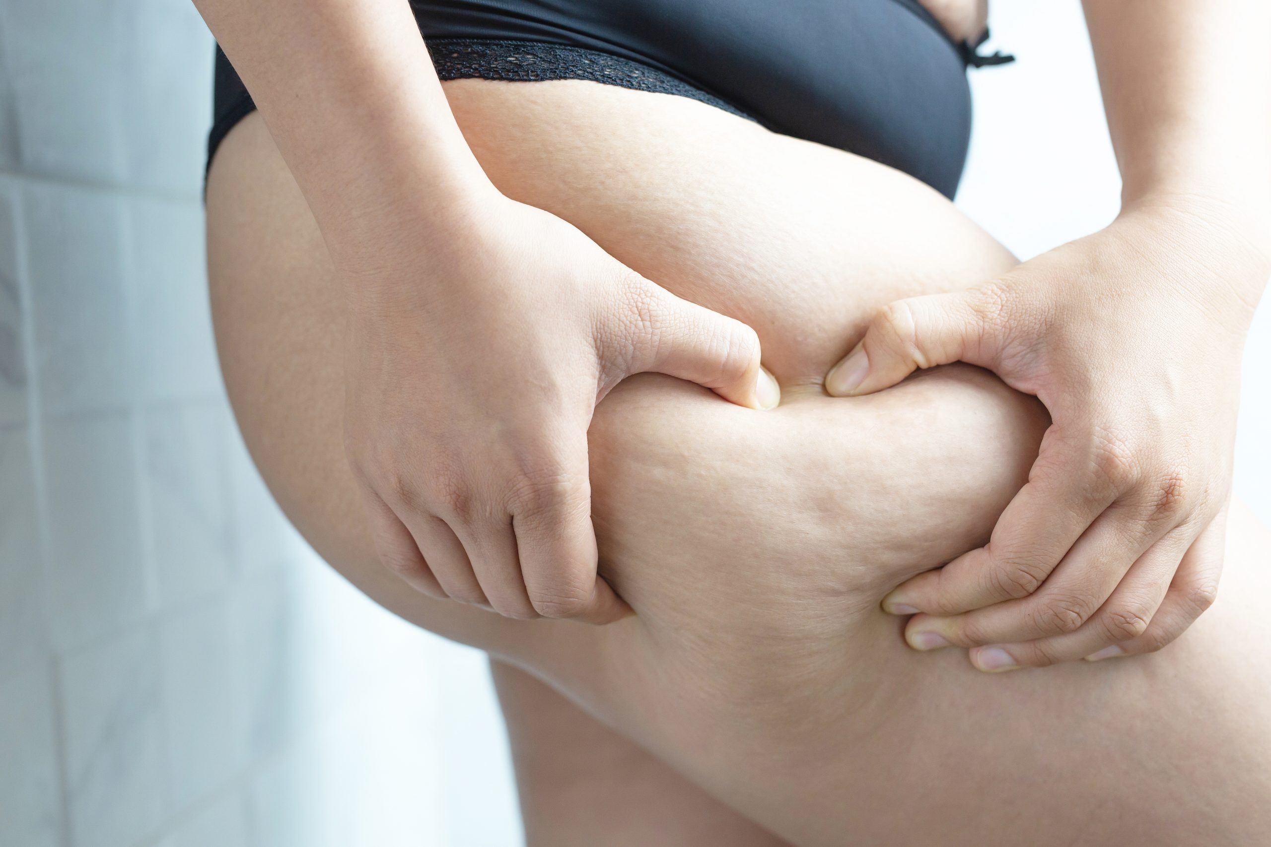 Clínica del lipedema