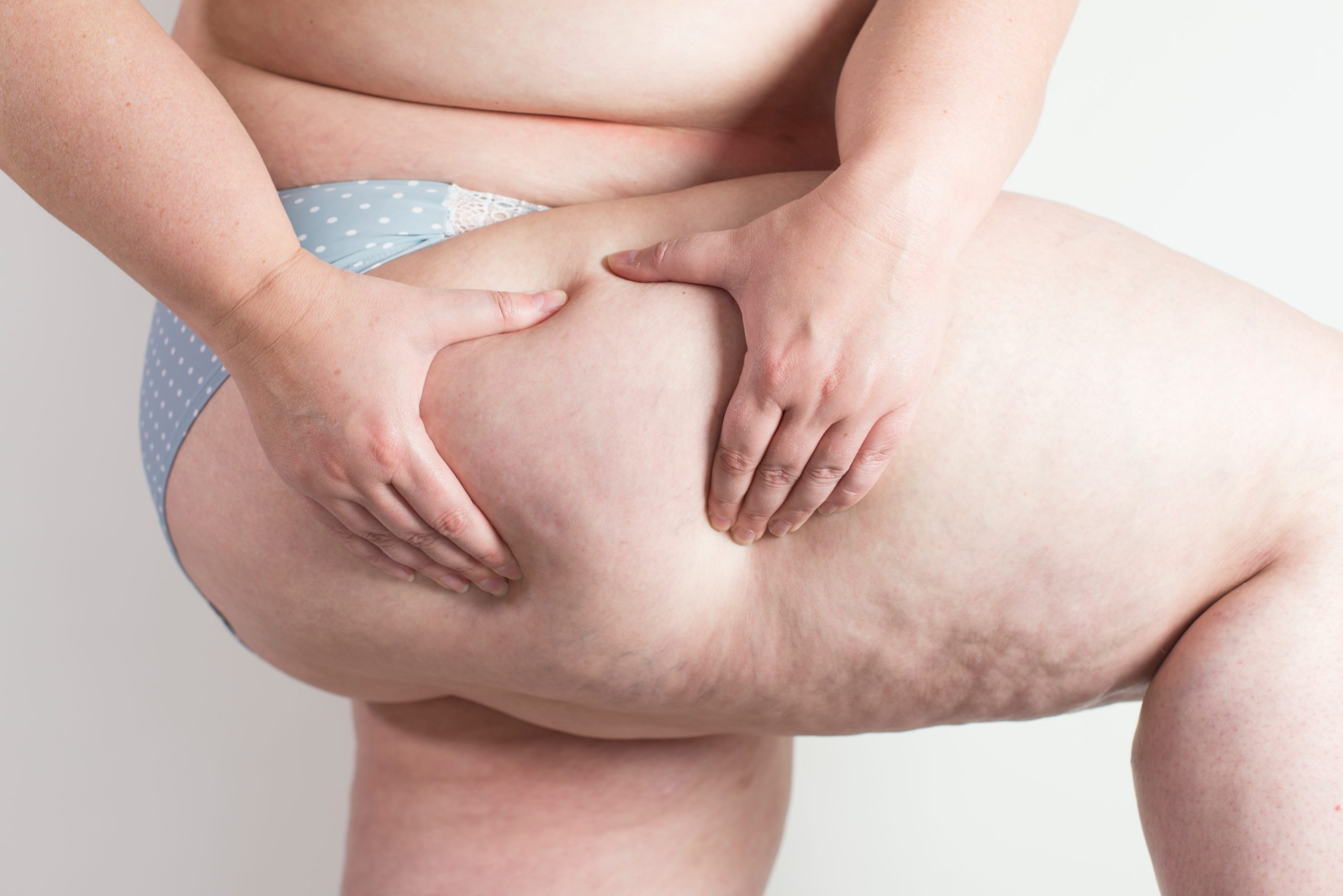 ¿Qué es el Lipedema?